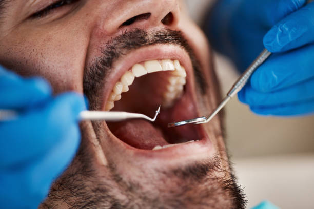 Best Emergency Dental Care for Broken or Chipped Teeth in Spruce Pine, NC